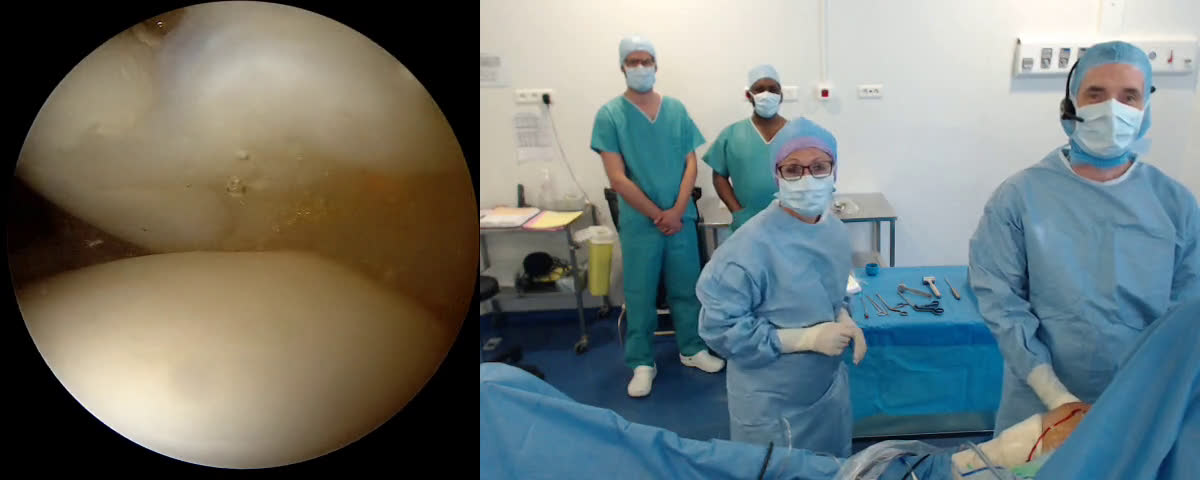 Arthroscopic partial thickness supra spinatus tear  repair with biceps entrapment  with  Dr Kunle Arogundade from Melbourne Australia (Dr. Joudet)