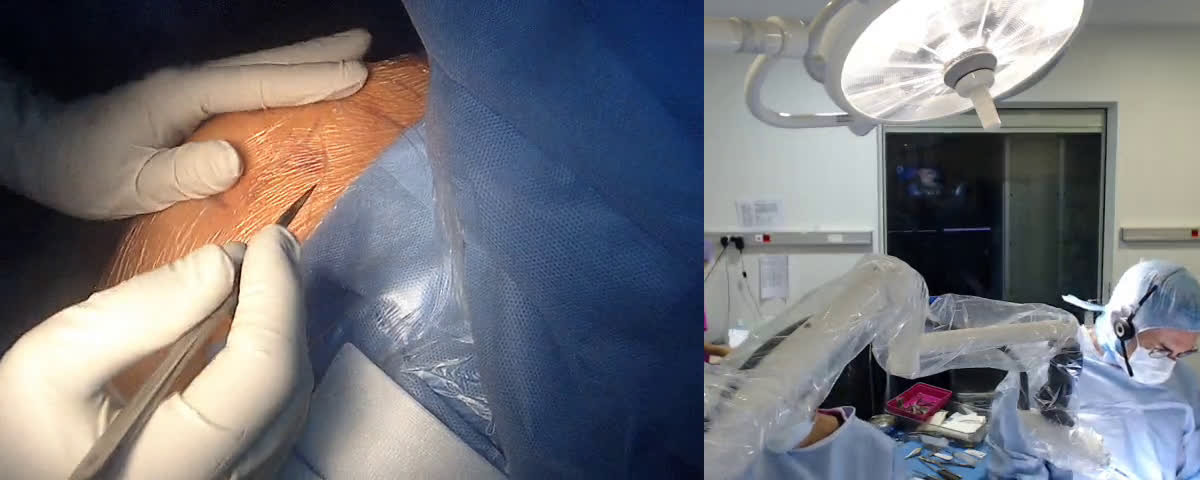 Arthroplastie totale inversée et transfert du grand dorsal par voie delta pectorale avec le Dr J.F. COSTE (Dr. Joudet)