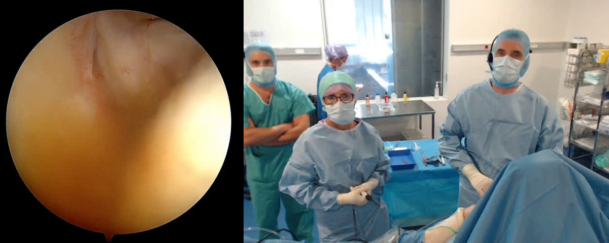 Réparation arthroscopique d’une rupture du sous scapulaire avec lésion partielle associée du sus épineux avec le Dr J.F. COSTE (Dr. Joudet)