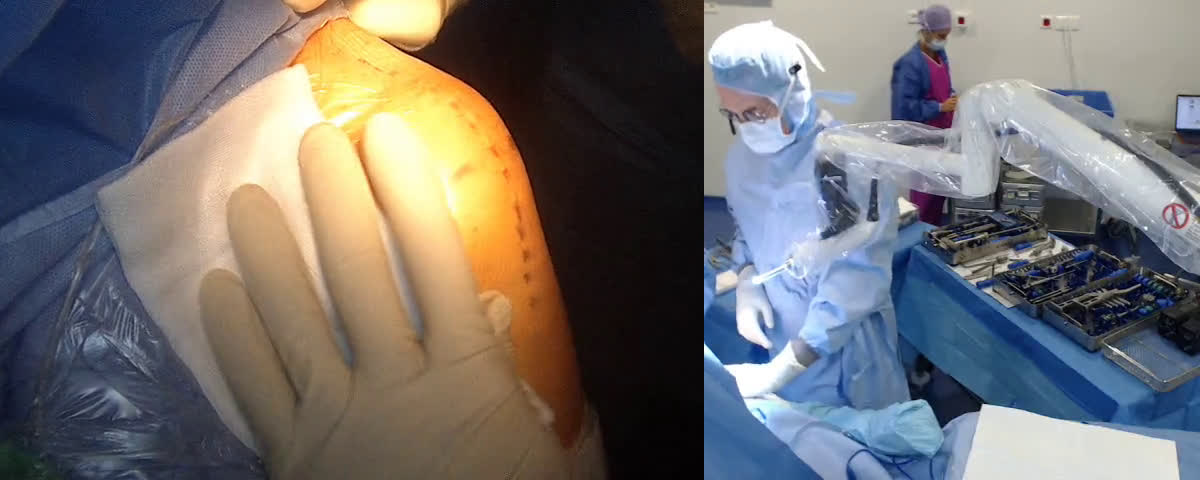 Changement d’une prothèse anatomique stemless par une prothèse inversée pour déficience de coiffe des rotateurs (Dr. Joudet)