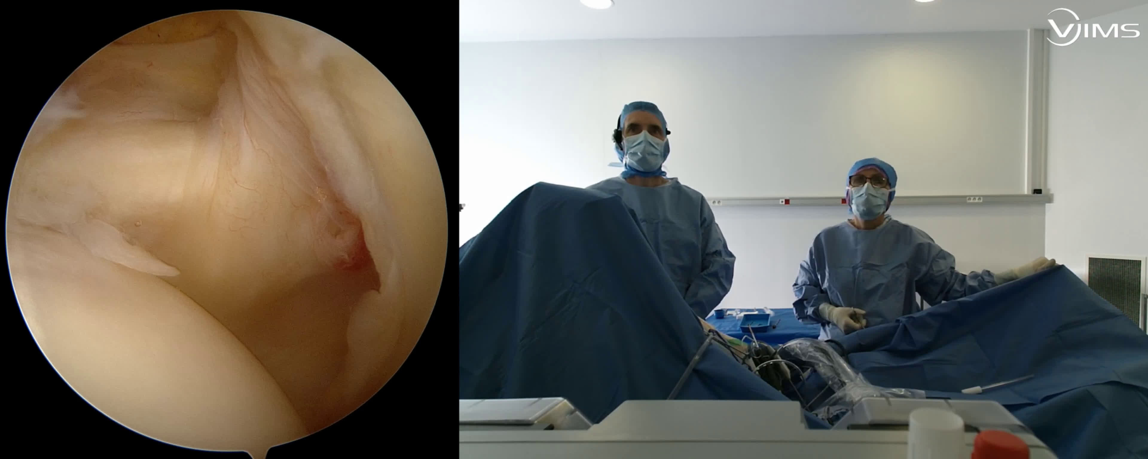 Résection du ¼ externe de la clavicule avec découverte d'une lésion de la face superficielle du supra-épineux (Dr. Joudet)