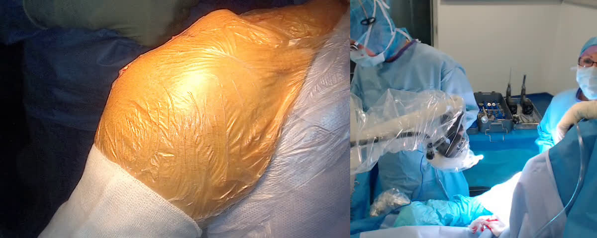 Reverse Total Shoulder Arthroplasty with Mathys system (Dr. Joudet)