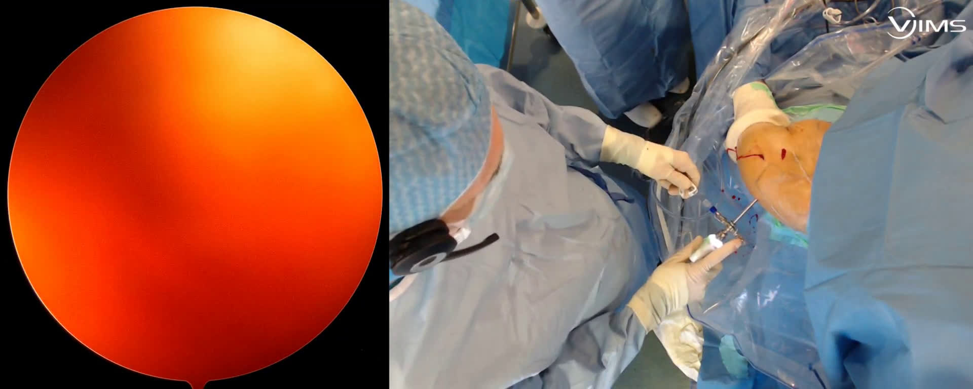Conseils pour un jeune chirurgien dans la réalisation d’une butée coracoïdienne d’épaule selon la technique de Latarget sous arthroscopie (Dr. Joudet)