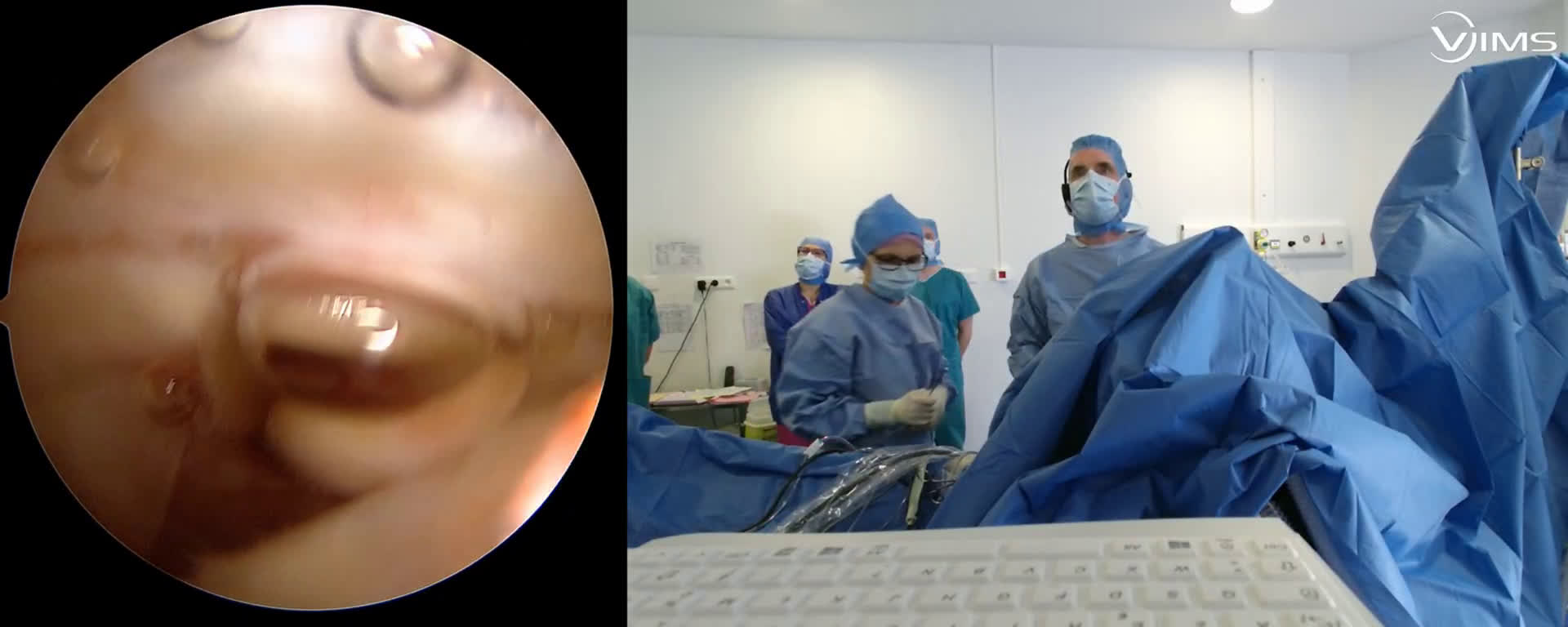 Réparation arthroscopique d'une rupture massive de la coiffe des rotateurs de l'épaule (Dr. Joudet)