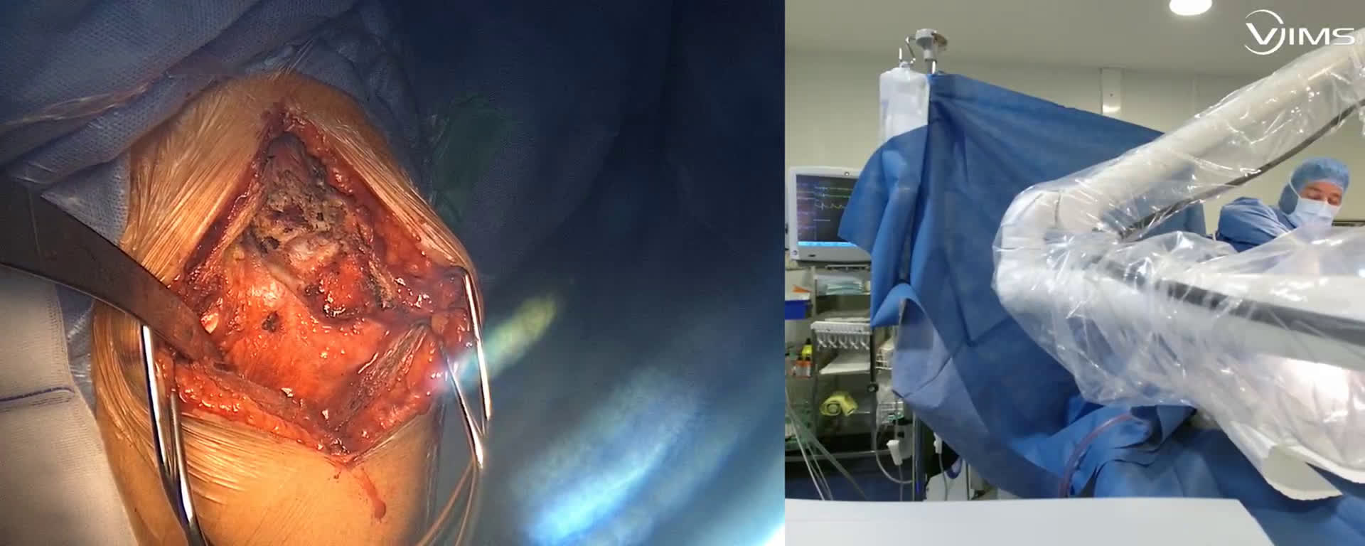 Comment ouvrir une articulation gléno-humérale et libérer le tendon du sub scapularis pour mettre en place une prothèse totale anatomique ? (Dr. Joudet)