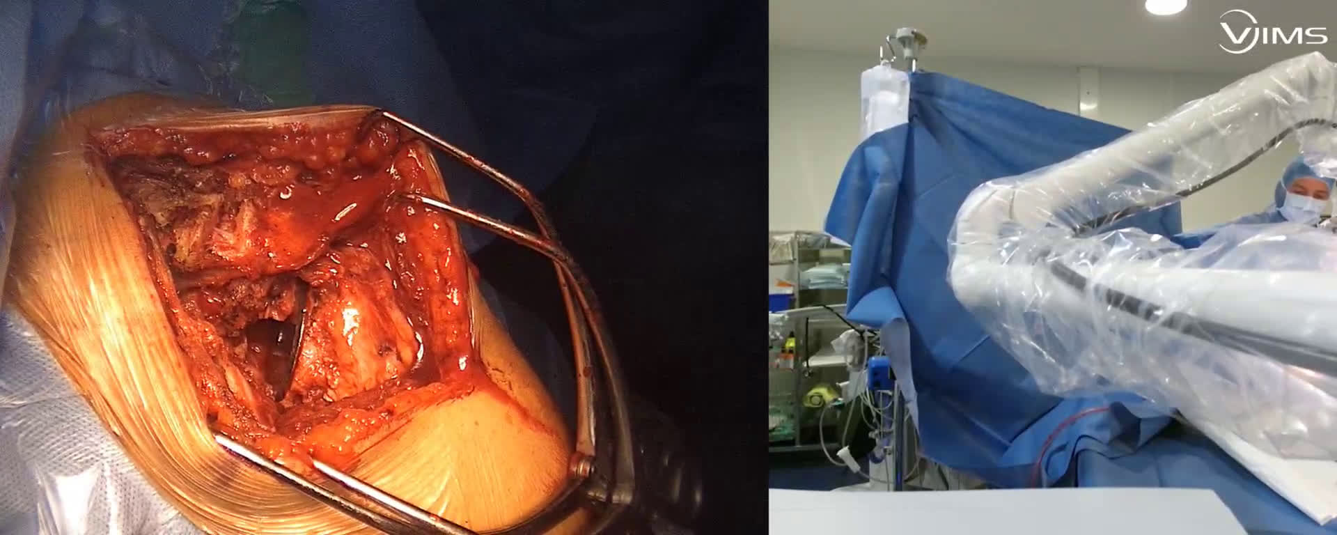 Comment réaliser la libération capsulaire péri glénoidienne   pour mettre en place une prothèse totale anatomique ? (Dr. Joudet)
