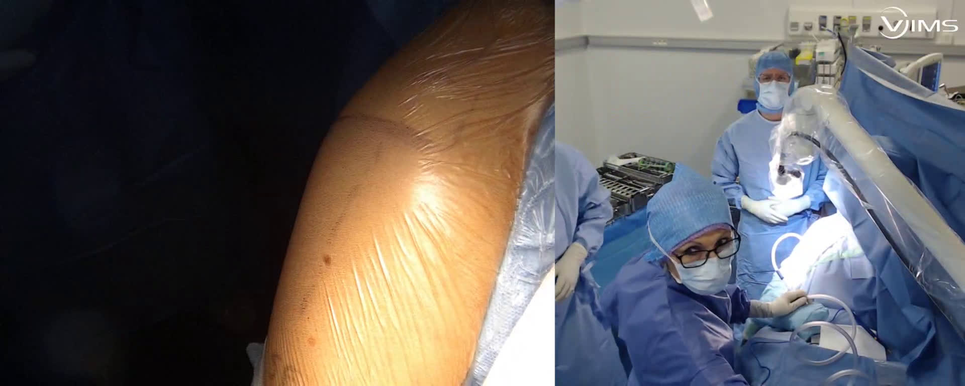 Arthroplastie totale inversée de l'épaule par voie latérale (prothèse MOVE UP ISA inlay) avec le Dr Raphael PINET (Dr. Joudet)