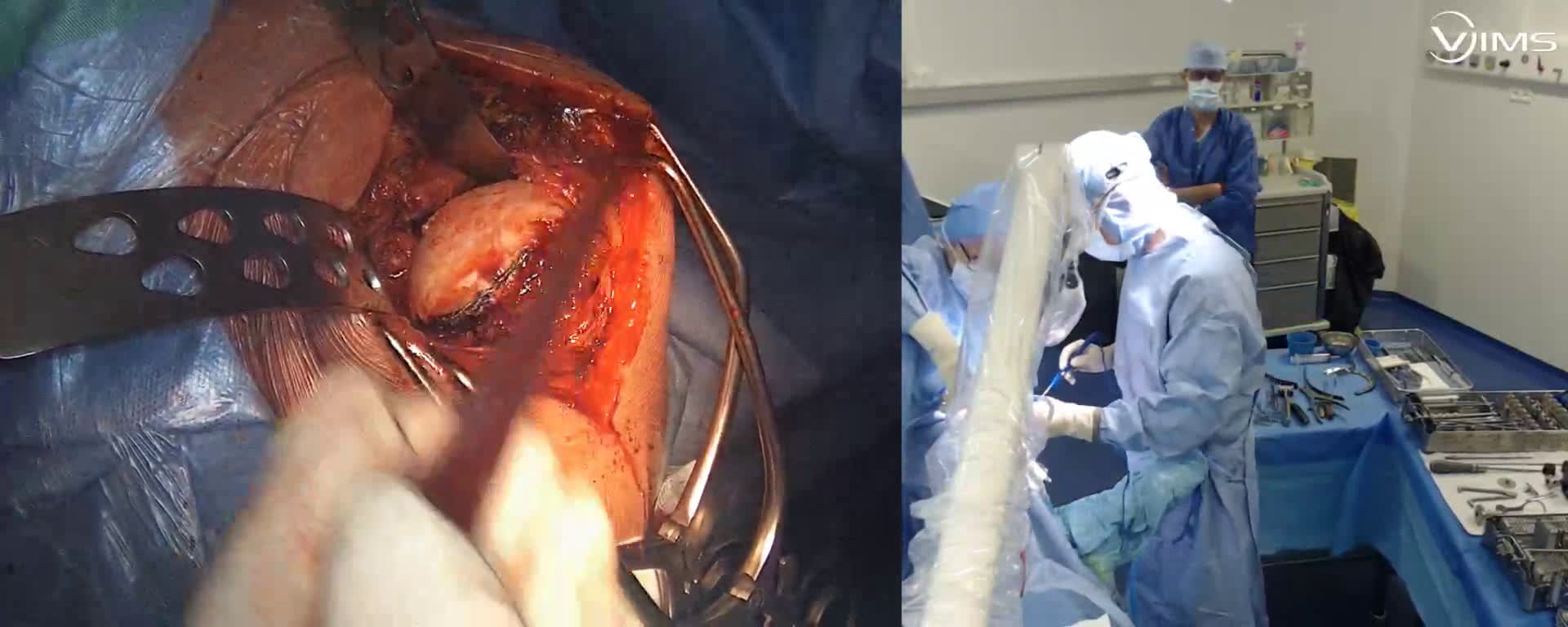 Préparation de l’humerus pour mise en place d’une prothèse totale d’épaule anatomique Stemles ISA (Move’Up) (Dr. Joudet)