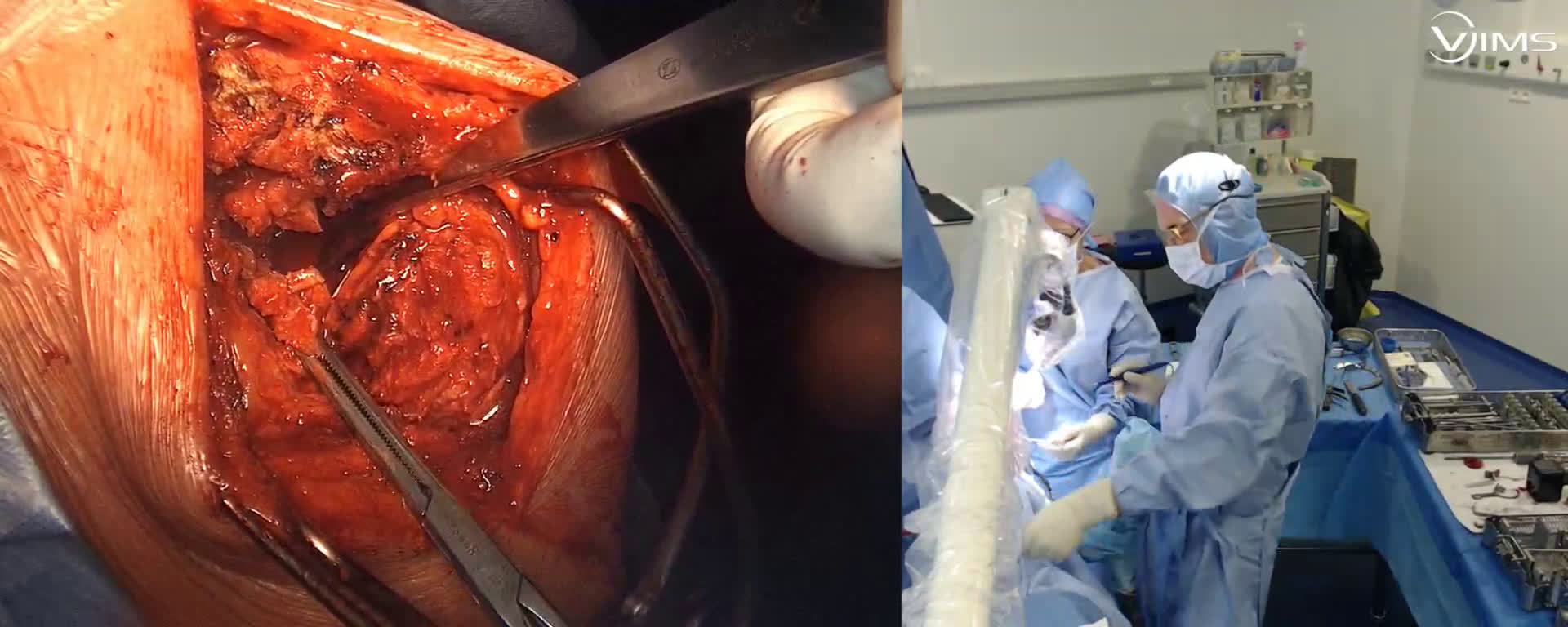 Préparation de la glène et mise en place d’un implant hybride non cimenté d’une prothèse totale d’épaule anatomique Stemles ISA (Move’Up) (Dr. Joudet)