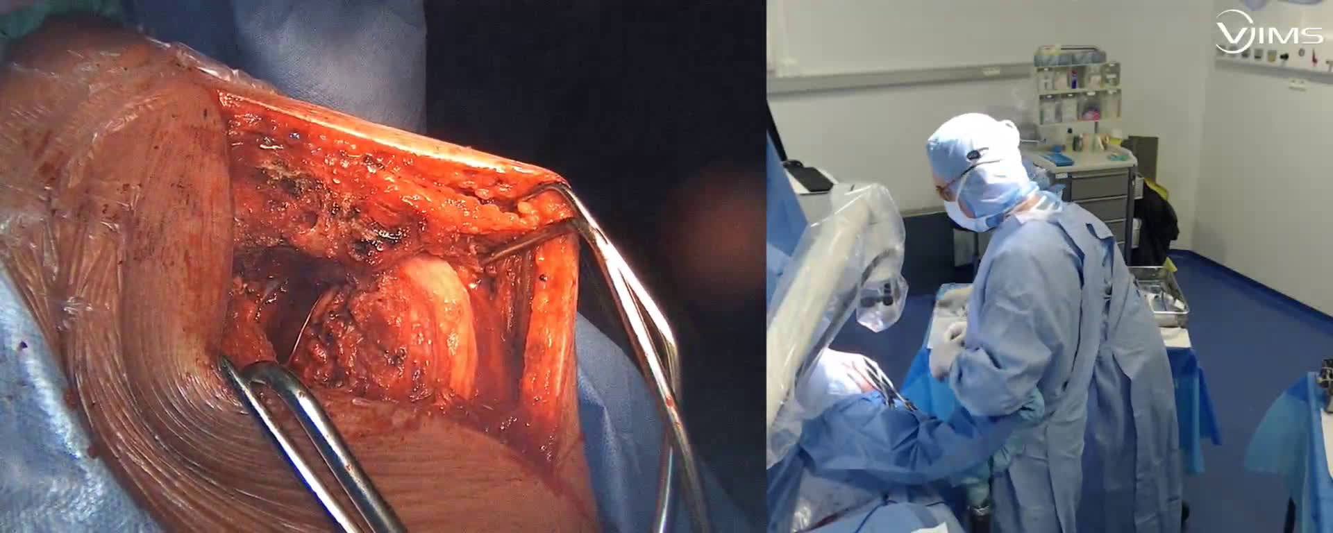 Comment je ré-insère un sous scapulaire après mise en place d’une prothèse totale d’épaule anatomique Stemles ISA (Move’Up) (Dr. Joudet)
