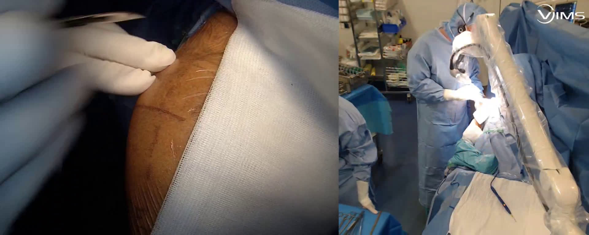 Voie d'abord latérale trans deltoïdienne de l'épaule pour l'implantation d'une prothèse totale inversée (Dr. Joudet)