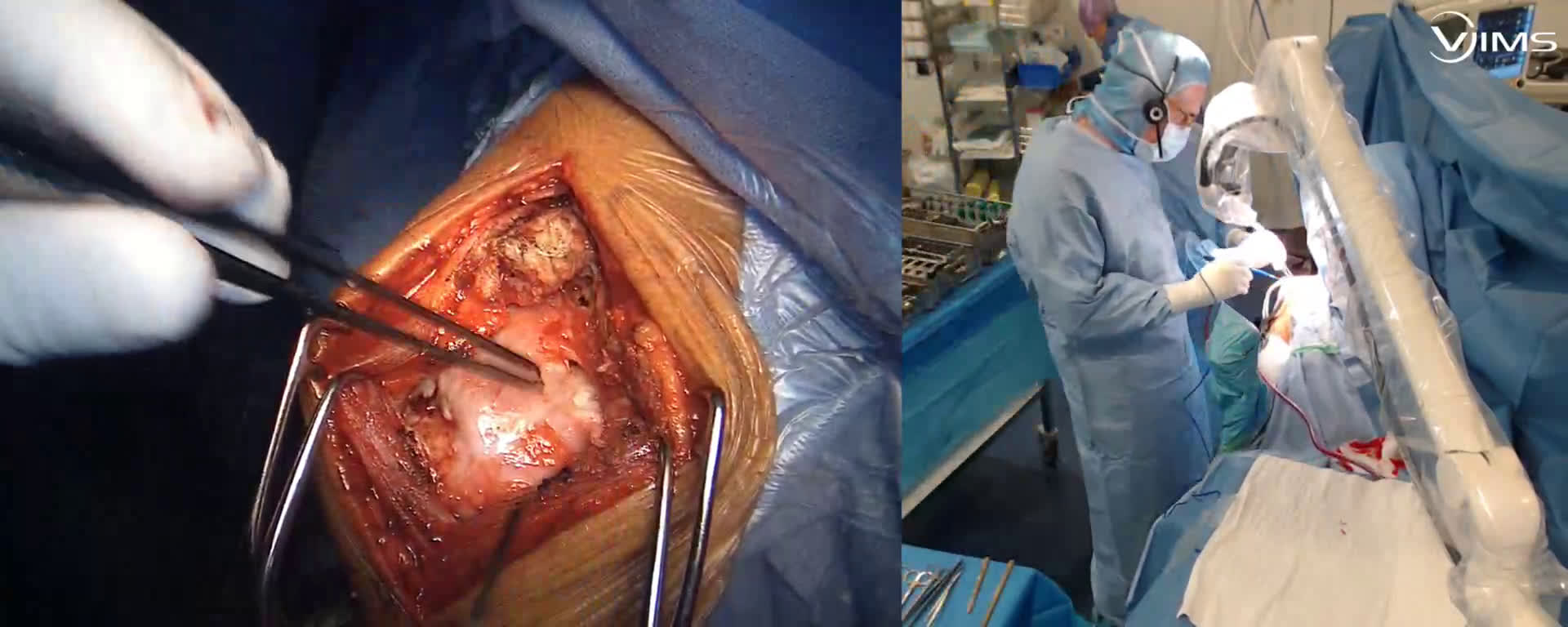 Ouverture de l'articulation  glénoïdaux humérale pour l'implantation  d'une prothèse totale inversée Move Up ISA inlay (Dr. Joudet)