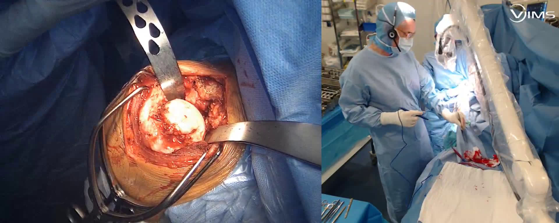 Préparation humérale  pour l'implantation d'une prothèse totale inversée Move Up ISA inlay (Dr. Joudet)
