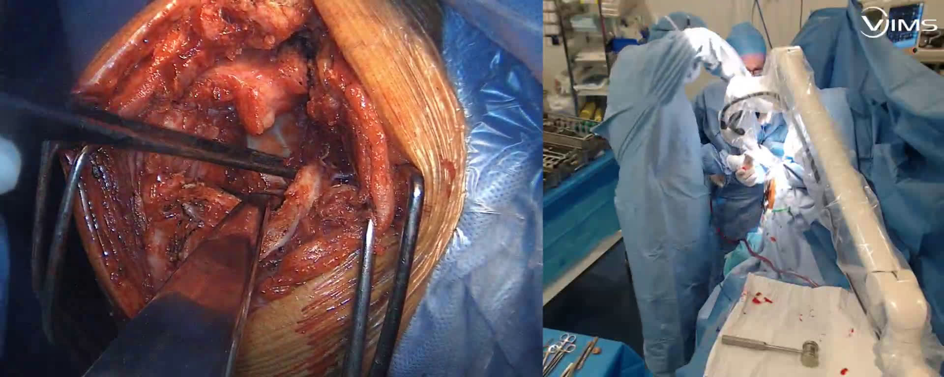 Préparation glénoidienne  pour l'implantation d'une prothèse totale inversée Move Up ISA inlay (Dr. Joudet)