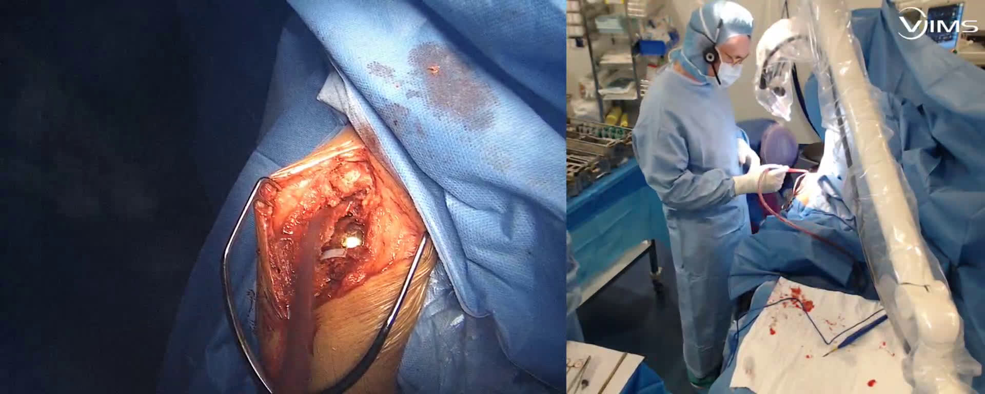 Fermeture de la voie d'abord latérale trans deltoïdienne de l'épaule après implantation d'une prothèse totale inversée (Dr. Joudet)