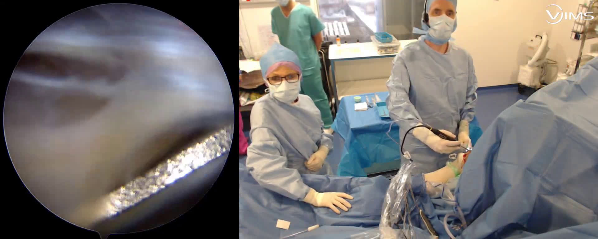 Réparation arthroscopique d'une rupture de la coiffe des rotateur de l'épaule par suture double rang type « speed bridge » (Dr. Joudet)