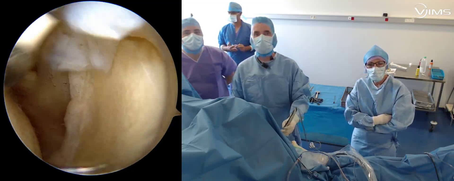 Réparation d’une lésion de la face profonde du tendon du supra épineux sous arthroscopie, Avec le Dr Sam AMHAZ de Saint Jacques De Compostelle (Dr. Joudet)