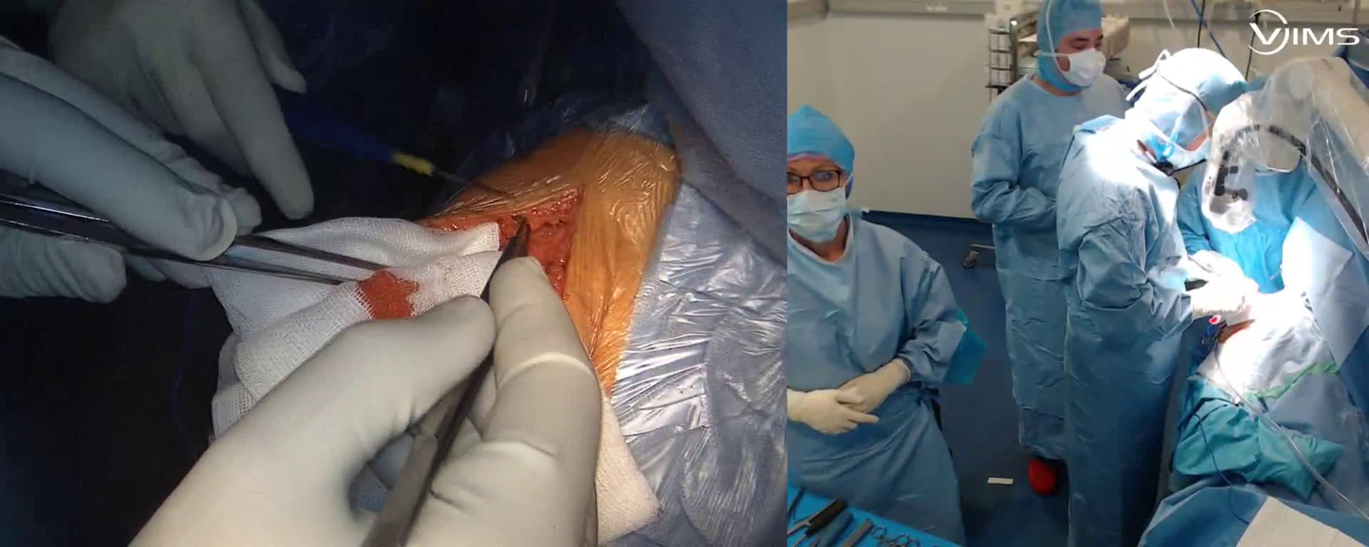 Arthroplastie totale inversée d'épaule ISA inlay Move Up avec le Dr Samer AMHAZ (Dr. Joudet)