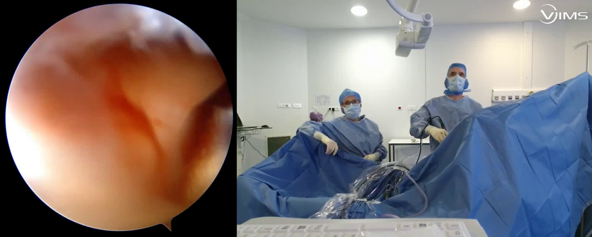 Vulgarisation de la technique de réparation arthroscopique d’une rupture isolée du supra épineux de l’épaule (Dr. Joudet)