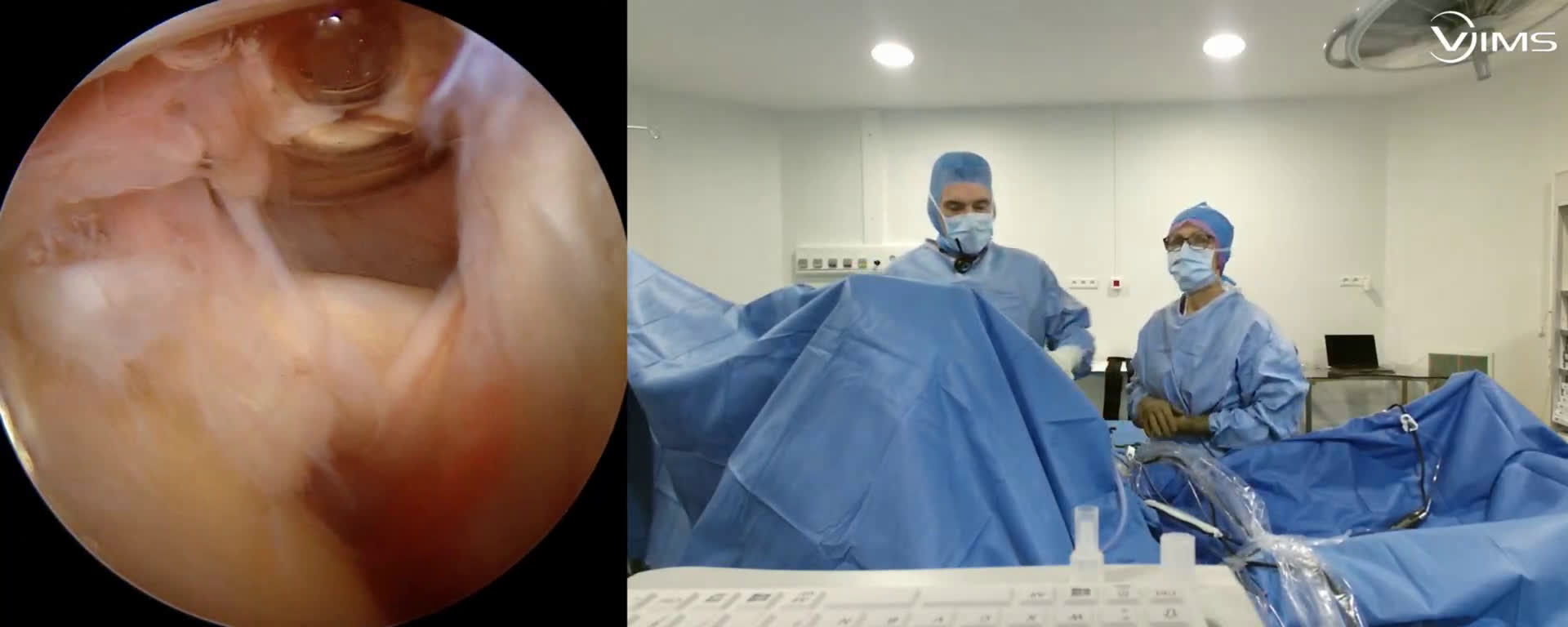 Vulgarisation de la technique opératoire d’une réparation des tendons de la coiffe des rotateurs de l’épaule sous arthroscopie pour les malades (Dr. Joudet)