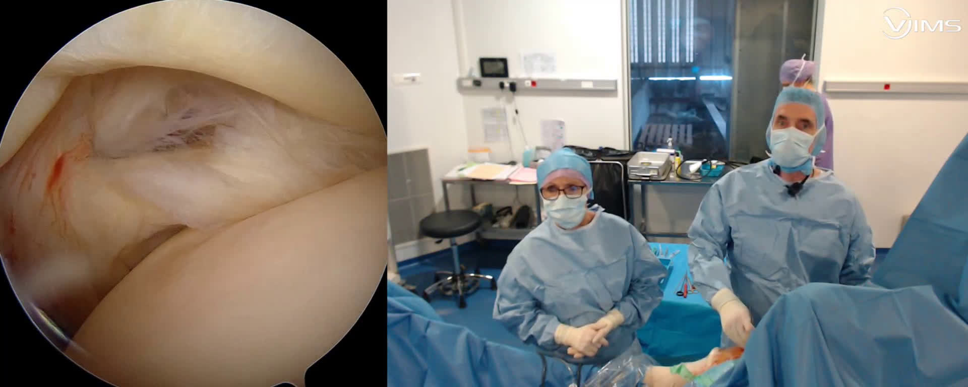 Réparation d’une lésion de la face superficielle du tendon du supra épineux de l’épaule sous arthroscopie (Dr. Joudet)