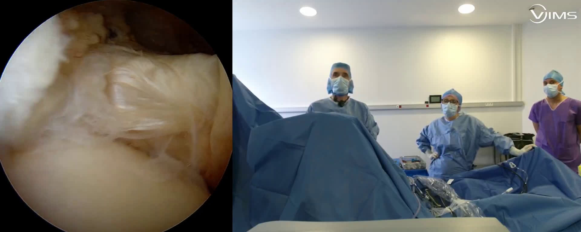 Réparation sous arthroscopie d’une lésion isolée du tendon du sous scapulaire de l’épaule (Dr. Joudet)