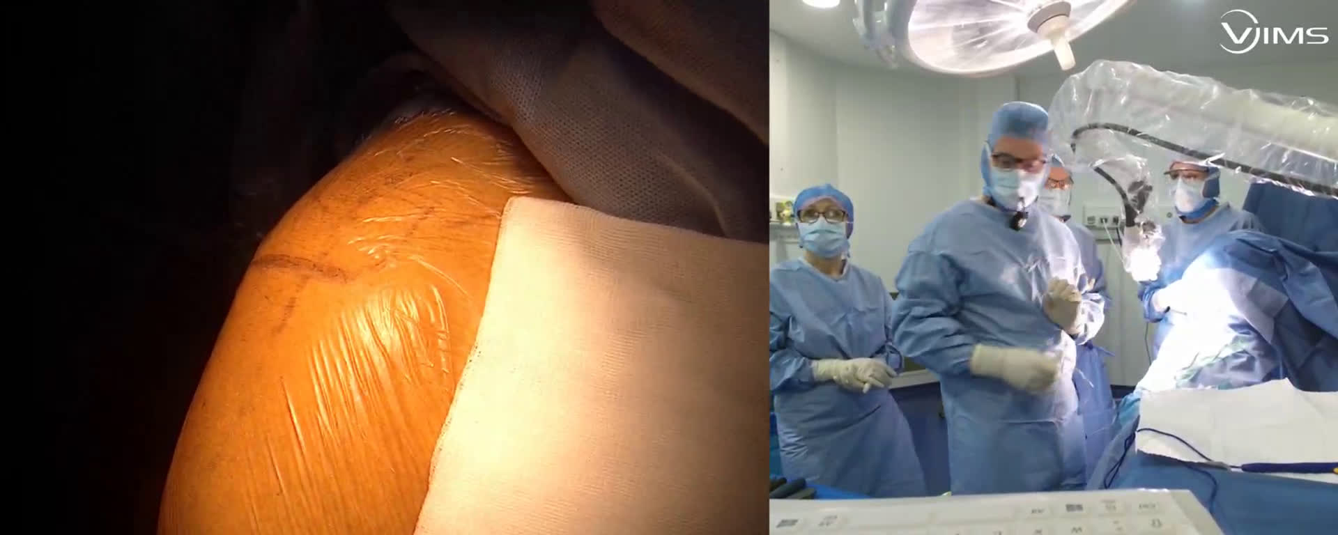 Arthroplastie totale d’épaule inversée (Move Up - ISA Inlay) par voie latérale avec le Dr Maxime PELISSIER (Dr. Joudet)