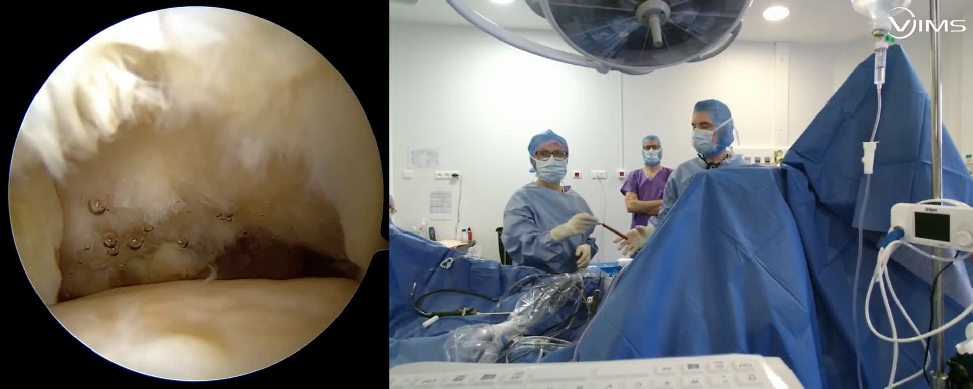 Réparation d'une rupture massive de la coiffe des rotateurs de l’épaule avec le Dr Maxime PELISSIER (Dr. Joudet)