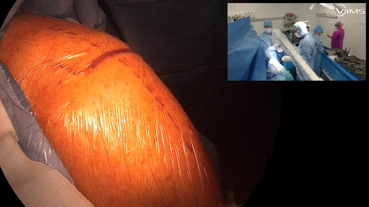 Arthroplastie totale d'épaule inversée avec un implant move up ISA inlay cimenté (Dr. Joudet)