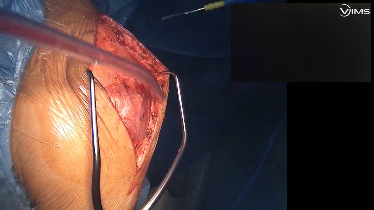 Exposition d'une glène difficile pendant une arthroplastie totale d'épaule inversée par voir latérale (Dr. Joudet)