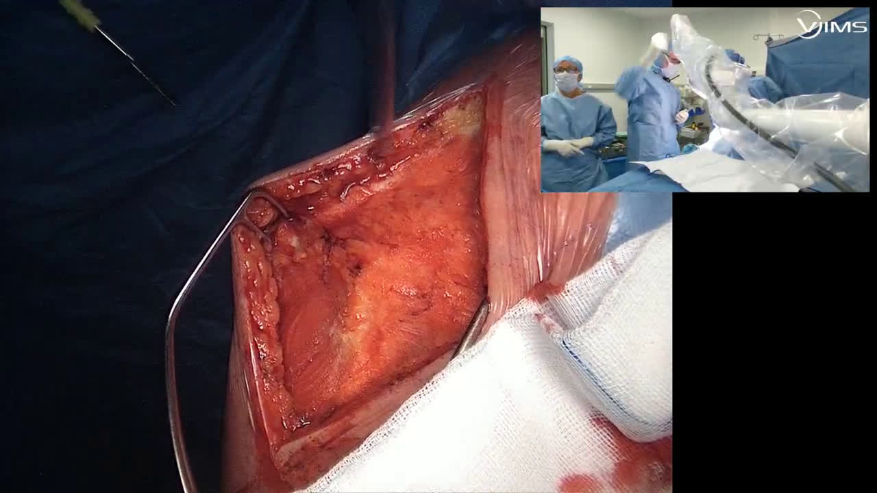 Utilisation d'une méthaglène compensée de 16° lors de la  mise en place d'une prothèse totale d'épaule inversée sur une usure postérieure de 30° (Dr. Joudet)