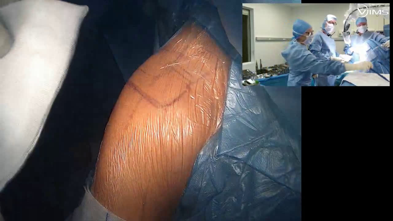 Trucs et astuces pour la mise en place d’une prothèse totale d’épaule inversée Move Up ISA inlay par voie latérale avec le DR Vadim AZOULAY (Dr. Joudet)