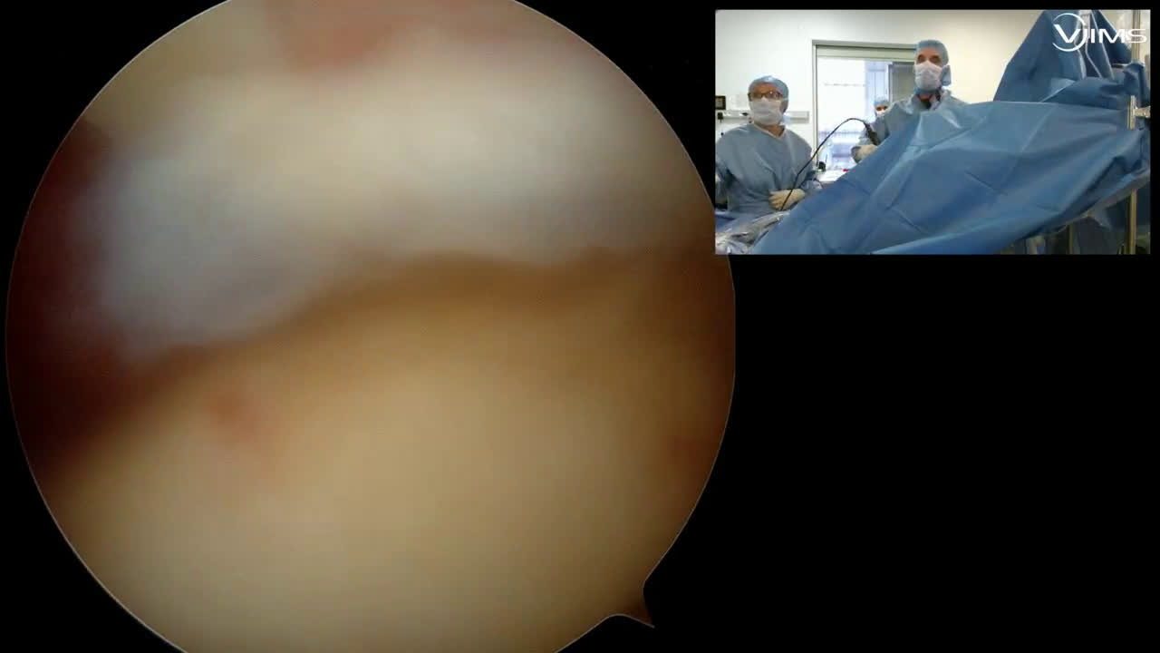 Réparation d’une lésion antéro-supérieure de la coiffe des rotateurs de l’épaule sous arthroscopie avec le DR Vadim AZOULAY (Dr. Joudet)