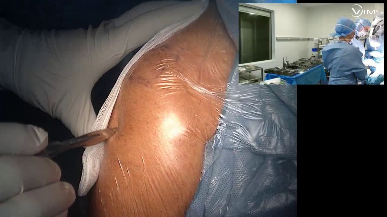 Arthroplastie totale d’épaule inversée (Move Up ISA inlay cimentée) par voie latérale avec le Dr Paul COMMEIL (Dr. Joudet)
