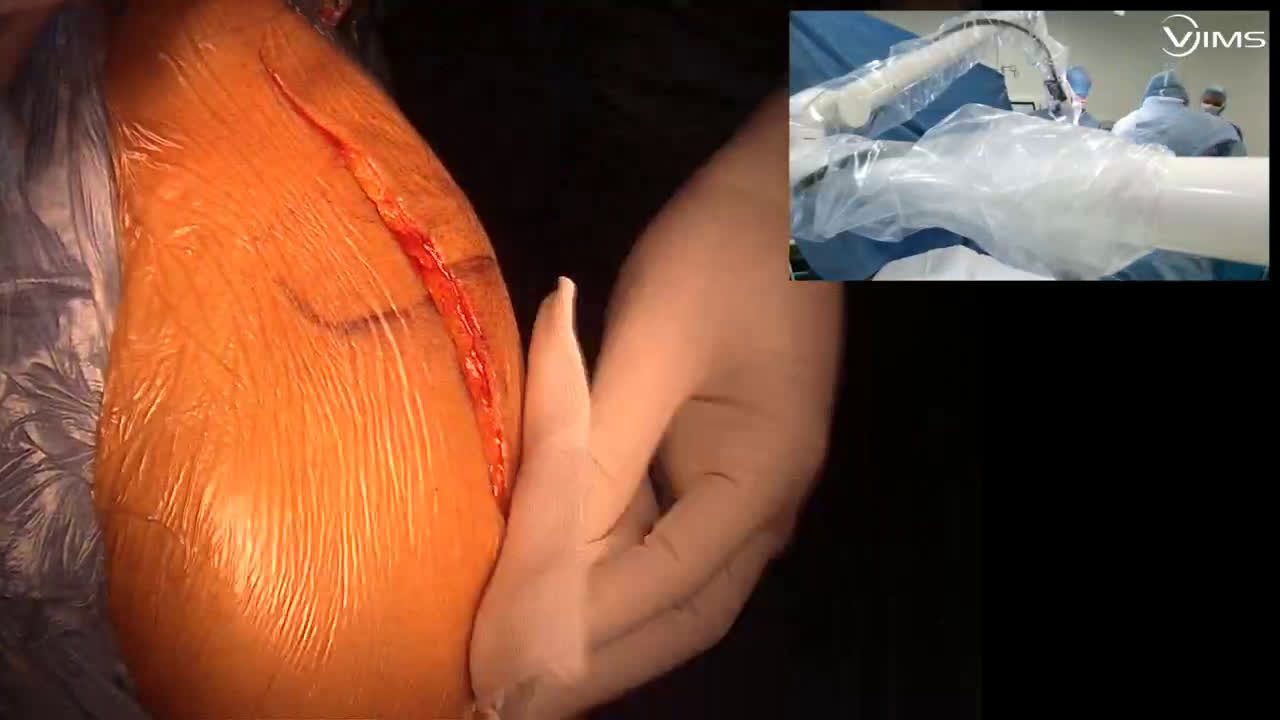 Trucs et astuces pour la réalisation d’une arthroplastie totale d’épaule inversée (Move Up ISA inlay cimentée) par voie latérale avec le Dr Paul COMMEIL (Dr. Joudet)