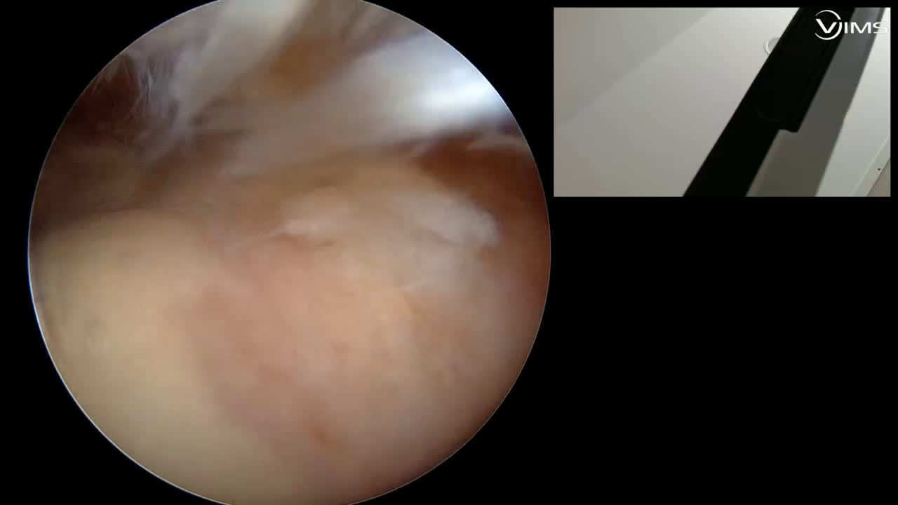 Réparation arthroscopique en double rang d’une lésion du tendon du supra épineux de l’épaule  avec le Dr Paul COMMEIL (Dr. Joudet)