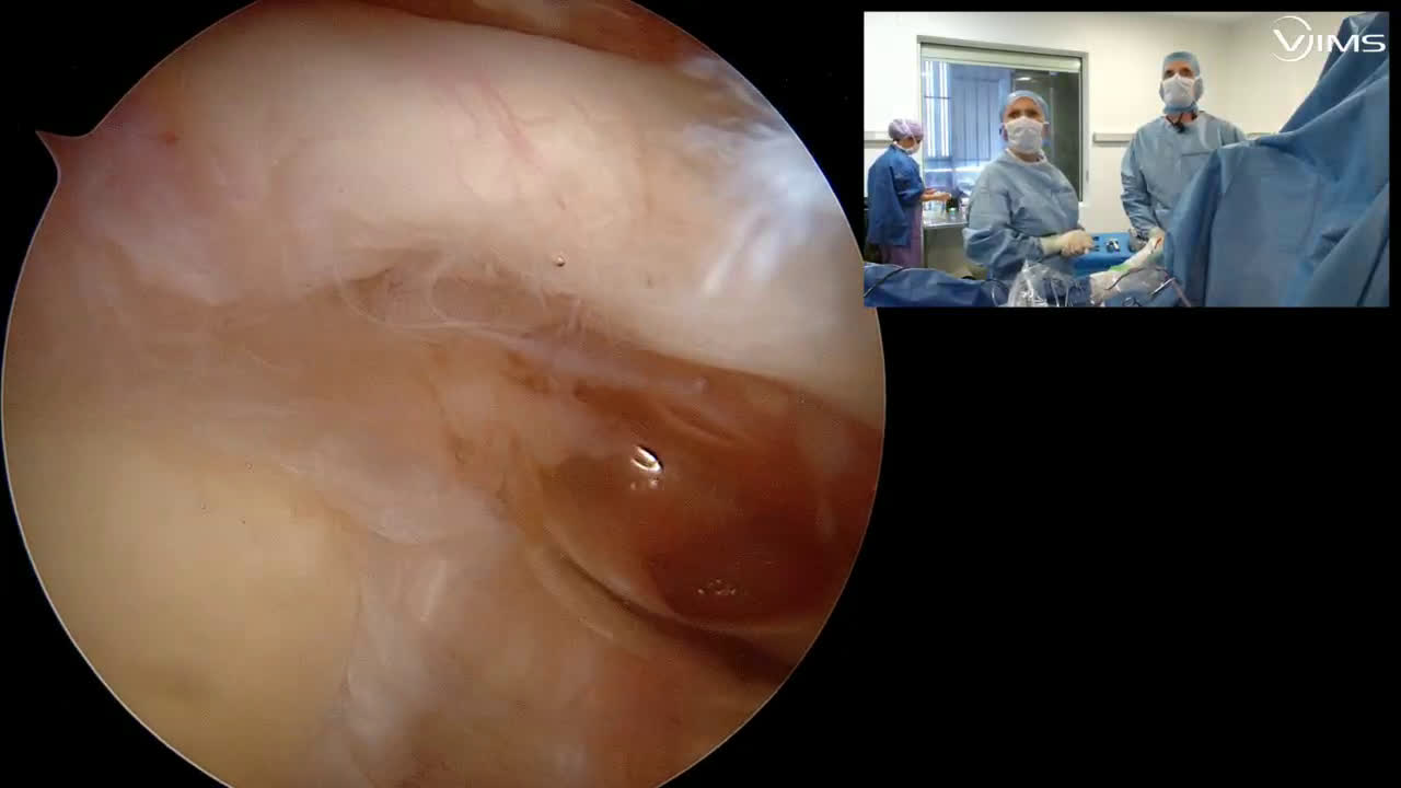 Utilisation de la technique shot lace pour une rupture de la coiffe des rotateur en « V » avec le Dr Paul COMMEIL (Dr. Joudet)