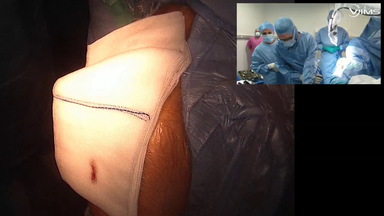 Arthroplastie totale d'Épaule inversée isa inlay cimentée par voie latérale (Dr. Joudet)
