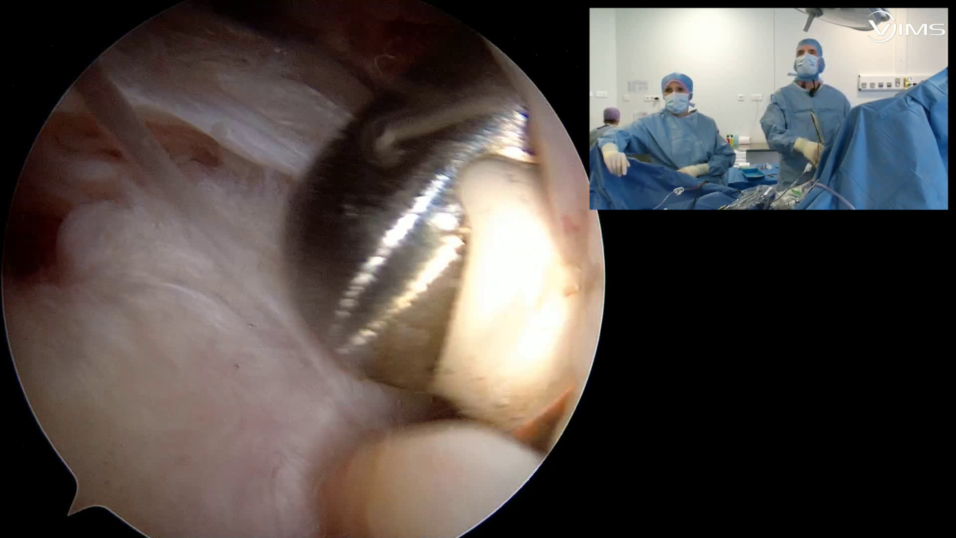 Réparation sous arthroscopie d’une lésion de la face superficielle « Elman 3 » du tendon du supra-épineux (Dr. Joudet)