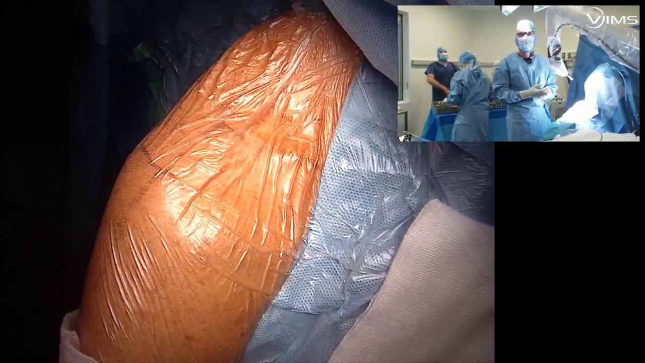 Arthroplastie totale d’épaule inversée Move Up isa inlay cimentée par voie latérale avec le Dr Saint Genes (Dr. Joudet)
