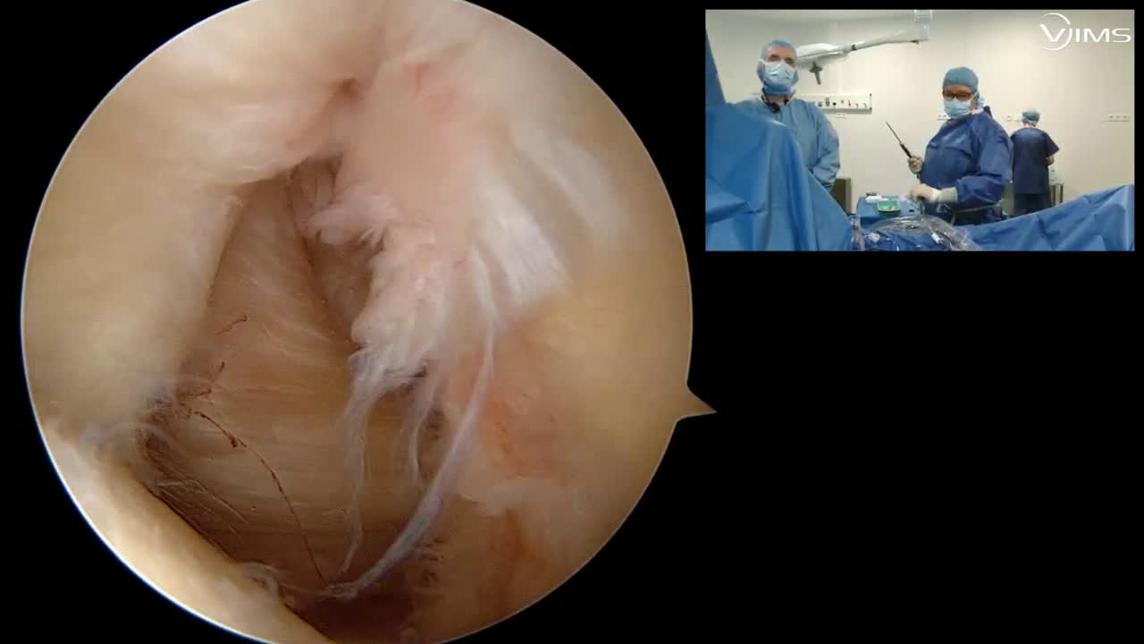 Réparation d'une rupture massive de la coiffe des rotateurs sous arthroscopie (Dr. Joudet)