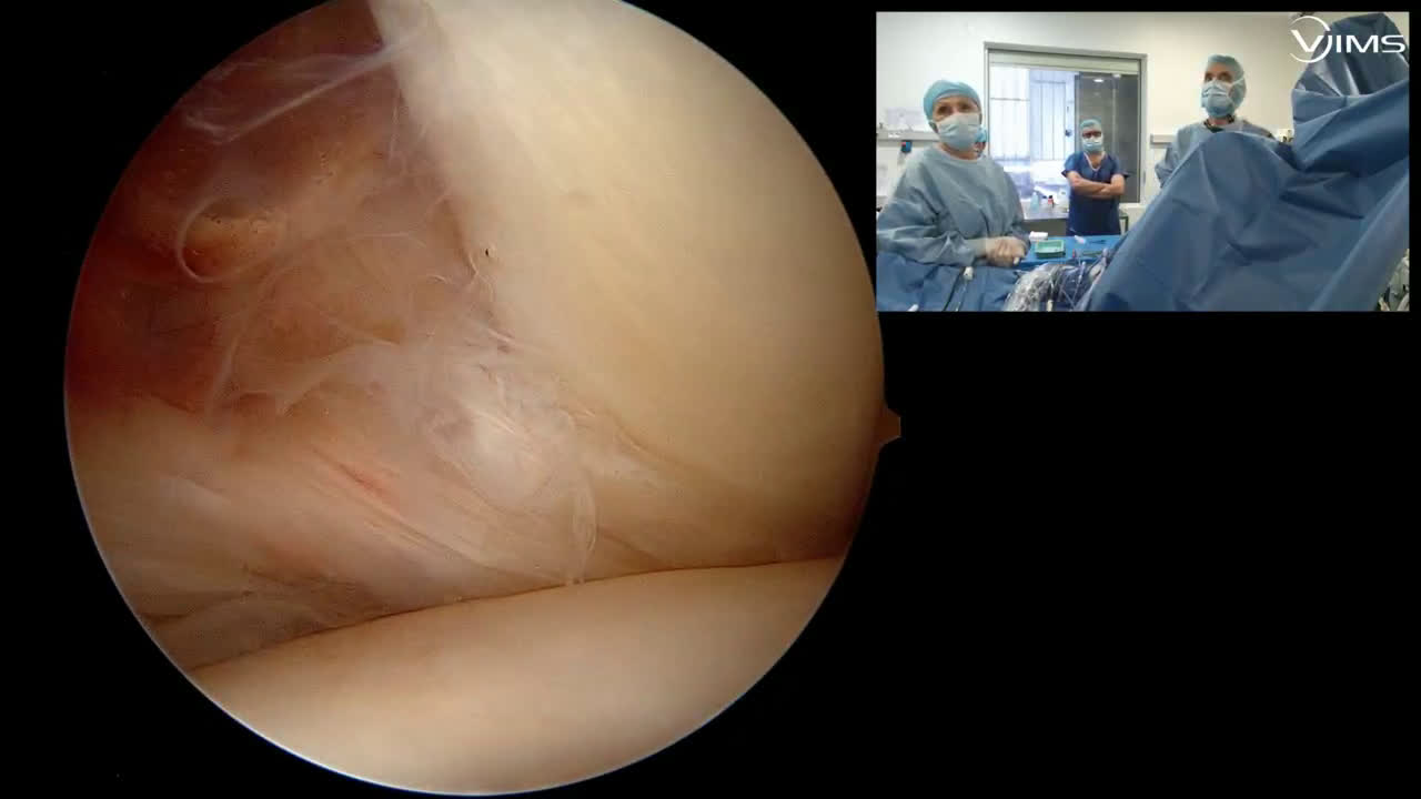 Comment rechercher pendant une arthroscopie d’épaule une rupture type 2 (classification SFA) du tendon du sub-scapularis avec le Dr Didier JOBARD (Dr. Joudet)
