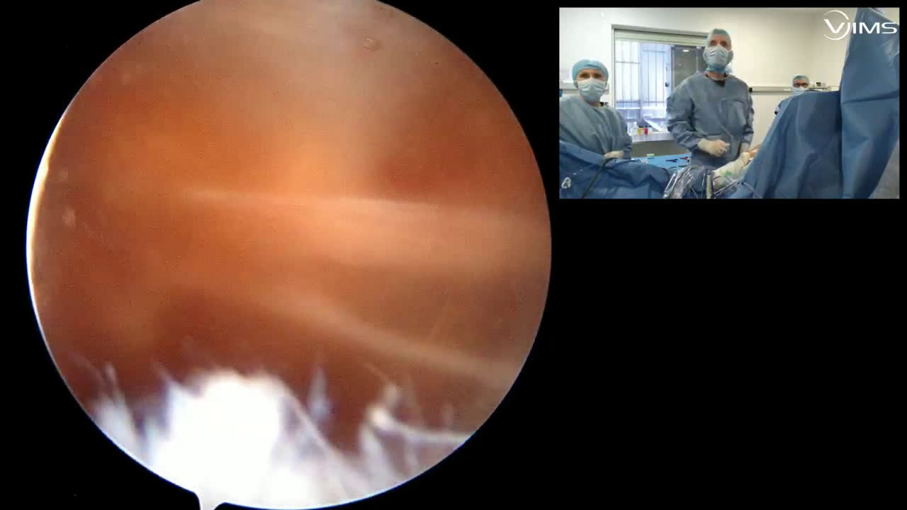 Réparation arthroscopique d’une rupture  type 4 (classification SFA) du tendon du sub-scapularis avec le Dr Didier JOBARD (Dr. Joudet)