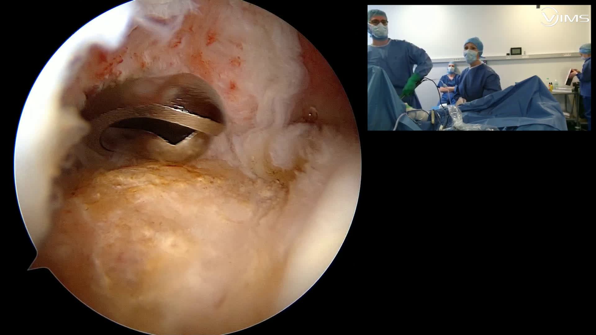 Arthroplastie totale d’épaule par voie latérale avec un implant Move Up ISA Stemless avec le Dr Didier JOBARD (Dr. Joudet)