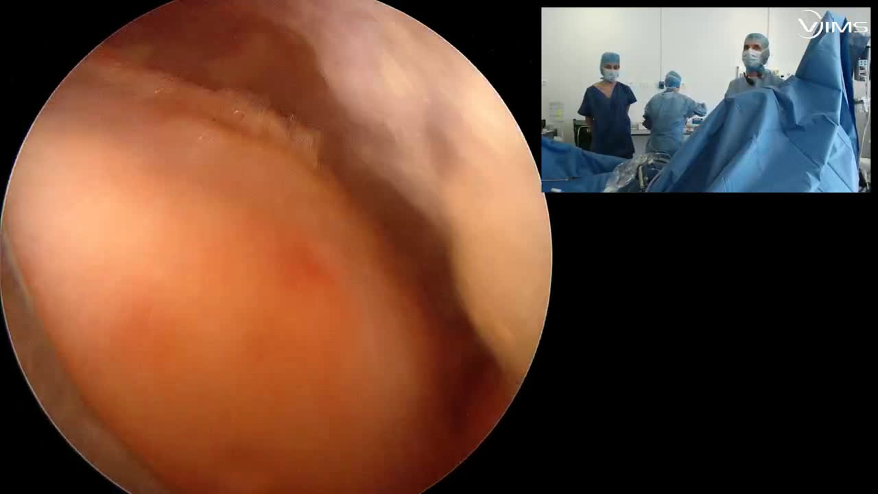 Exérèse d’une calcification de type 2 du tendon du supra épineux de l’épaule sous arthroscopie Avec le Dr Ines REGAS (Dr. Joudet)