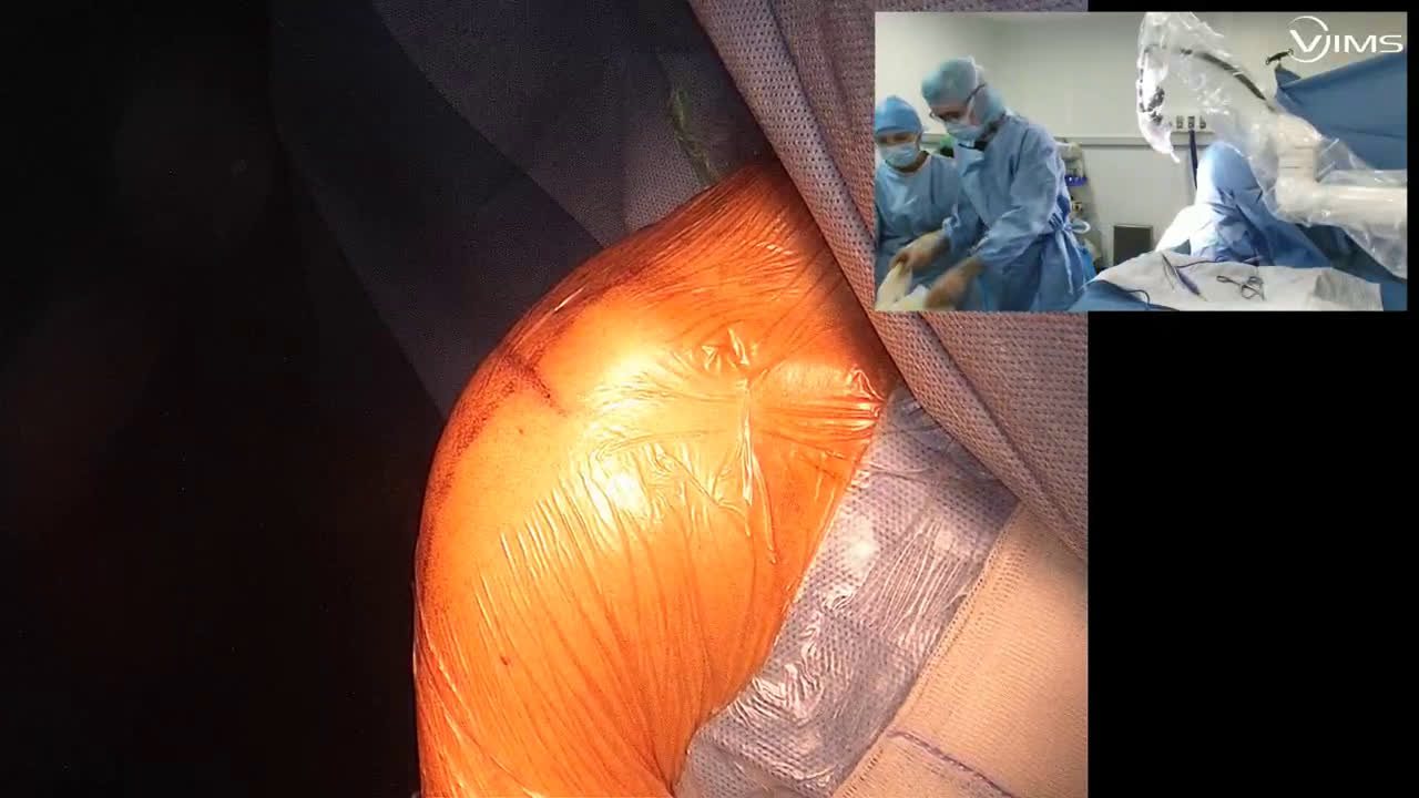 Arthroplastie totale d’épaule anatomique Move up ISA stemless par voie latérale (Dr. Joudet)
