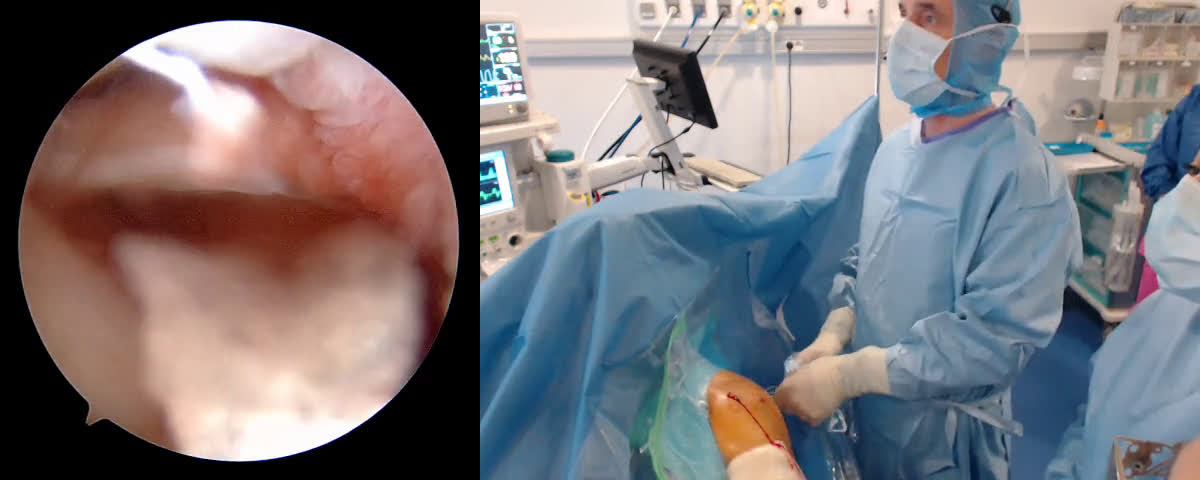 Massive Cuff Tear managed under arthroscopy with Dr Angelo from Portugal (Dr. Joudet)