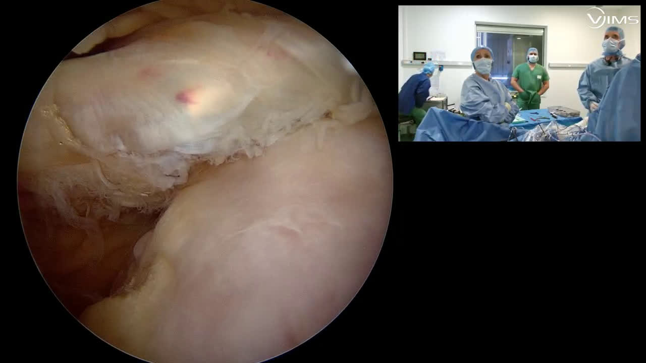 Réparation sous arthroscopie de la coiffe des rotateurs de l’épaule avec le Dr Remy VIGIER (Dr. Joudet)