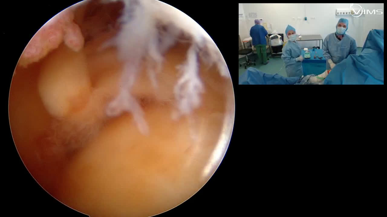Réparation arthroscopique d’une rupture massive postero-supérieure de la coiffe des rotateurs de l’épaule (Dr. Joudet)