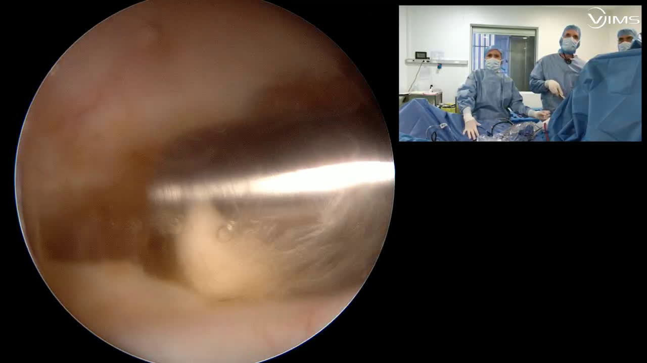 Réparation arthroscopique d’une rupture massive postero-supérieure de la coiffe des rotateurs de l’épaule (Dr. Joudet)